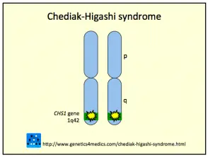 Síndrome de Chediak Higashi