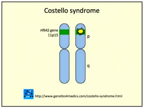 costello-syndrome__protectwyjqcm90zwn0il0_focusfillwzi5ncwymjisingildfd-3422087-4426929