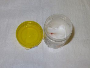 Biopsia por punción transportada en una gasa empapada en solución salina