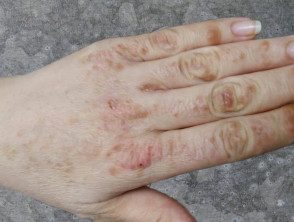 Síndrome de pies y manos debido a sorafenib