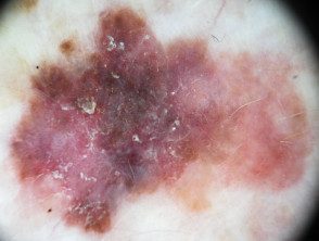 Dermatoscopia de carcinoma intraepidérmico pigmentado