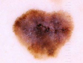 Dermoscopia invasiva de melanoma, Breslow 0.4 mm dentro de un melanoma in situ, con presencia de nevus asociado