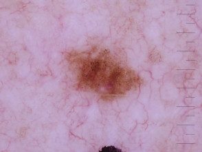 Dermatoscopia de melanoma in situ