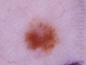 Dermatoscopia de melanoma in situ