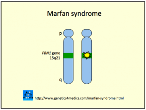 marfan-syndrome__protectwyjqcm90zwn0il0_focusfillwzi5ncwymjisingildjd-6978771-3172356