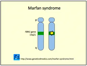 marfan-syndrome__protectwyjqcm90zwn0il0_focusfillwzi5ncwymjisingildjd-6978771-3172356