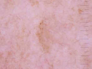 Líneas anguladas en dermatoscopia de melanoma