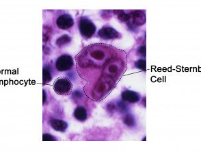 reed-sternberg-lymphocyte-nci-vol-7172-300__protectwyjqcm90zwn0il0_focusfillwzi5ncwymjisingildi2xq-8155685-8817947