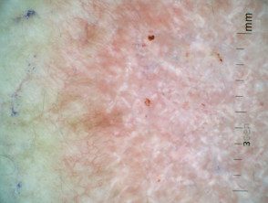 Dermatoscopia superficial de carcinoma basocelular