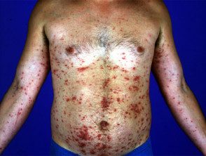 Eczema secundario diseminado