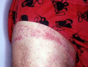 Dermatitis de goma