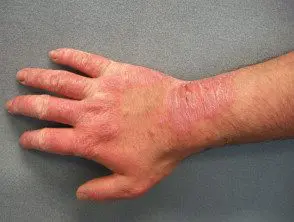 Dermatitis de contacto alérgica al caucho.