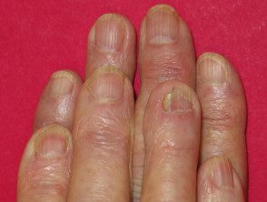 Acitretina adelgazamiento de uñas