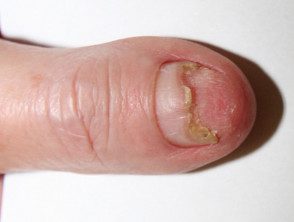 Acrodermatitis continua de Hallopeau después de 2 meses de uso de ungüento de clobetasol