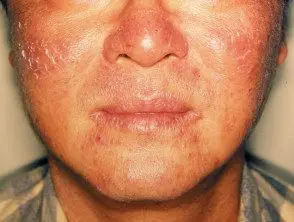 Dermatitis actínica crónica