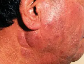 Dermatitis actínica crónica