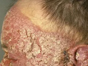 Dermatitis actínica crónica