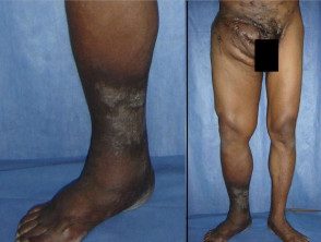 actinomycetoma-foot-and-legs-v2__protectwyjqcm90zwn0il0_focusfillwzi5ncwymjisingildjd-6652861-7271897