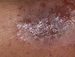 Eczema agudo
