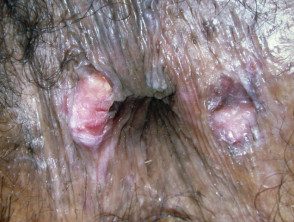 Carcinoma de células escamosas perinales in situ