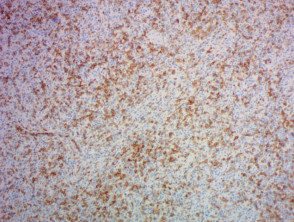 Patología del linfoma angioinmunoblástico de células T con tinción PD1 x 100