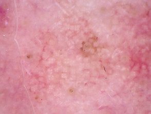 Rosetones en queratosis actínica