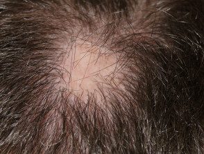 alopecia-areata-atnf__protectwyjqcm90zwn0il0_focusfillwzi5ncwymjisingildfd-3212141-1340217