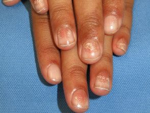 Alopecia areata uñas