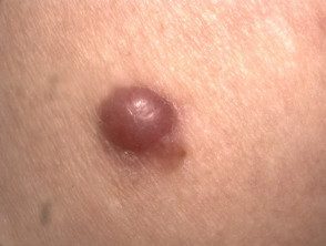 Macro melanoma amelanótico