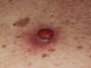 Dermatoscopia de melanoma amelanótico