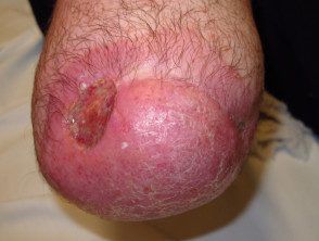 Dermatosis del muñón de amputación
