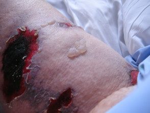 Problemas de la piel que afectan un muñón de amputación