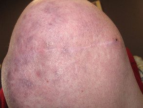 Problemas de la piel que afectan un muñón de amputación