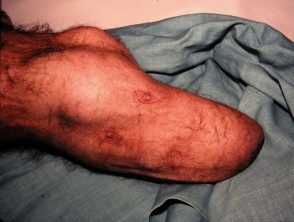 Cáncer de piel que surge en la extremidad del amputado.