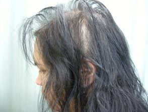 Efluvio de Anagen: alopecia areata