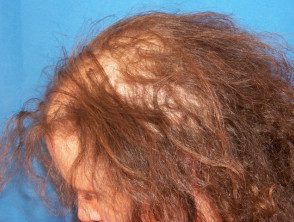 Efluvio de Anagen: alopecia areata