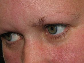 Efluvio de Anagen: pérdida de cejas en la alopecia areata