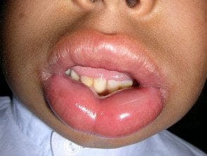 angioedema1__protectwyjqcm90zwn0il0_focusfillwzi5ncwymjisingildfd-9111202-8766922