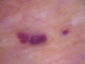 Dermatoscopia de angioqueratoma de Fordyce en vulva