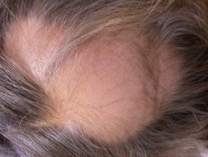 Alopecia areata - Hoogstra - Medical Centers