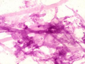 Mancha PAS de Aspergillus visto en una biopsia de piel