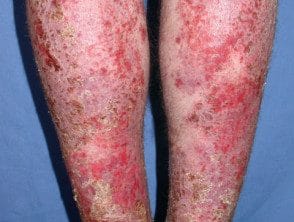 Dermatitis infectada