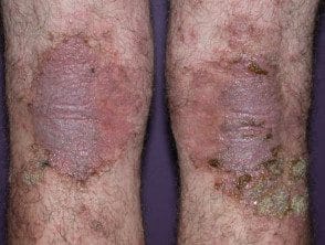 Complicaciones de la dermatitis - Hoogstra - Centros Medicos