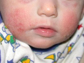 Eczema atopico