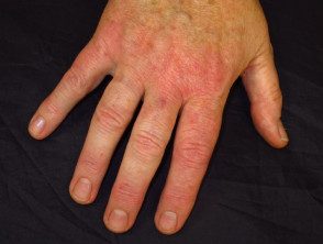 Dermatitis atópica de la mano