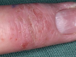 Eczema atópico de la mano