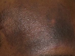 atopic-eczema-black-skin__protectwyjqcm90zwn0il0_focusfillwzi5ncwymjisinkildg1xq-4810031-4466196