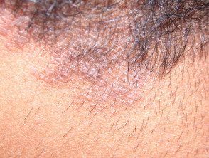 Dermatitis atópica del cuero cabelludo.