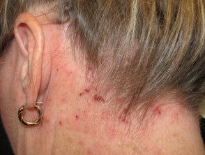 Dermatitis atópica del cuero cabelludo.