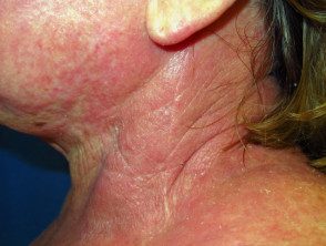 Dermatitis atópica que afecta el cuello.